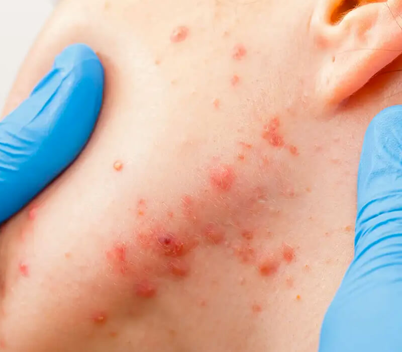 Tratamento para Acne